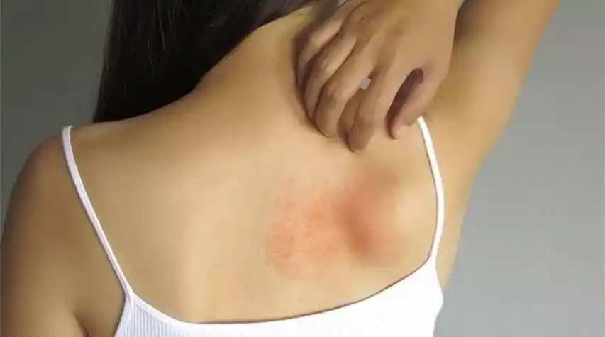 一换季皮肤就干痒,是皮肤病吗?3 招教你正确应对