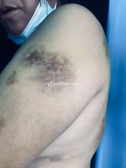 典型皮损狼疮性脂膜炎