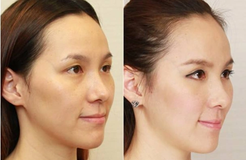 一组对比图告诉你自体脂肪丰苹果肌效果好不好