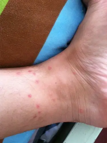 有没有谁知道被跳蚤咬了怎么办 好多胞 满意的追加50分 谢谢了