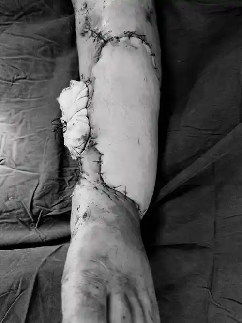 永鼎医讯丨遭遇车祸险截肢,骨科妙手"补肉"成功保肢!