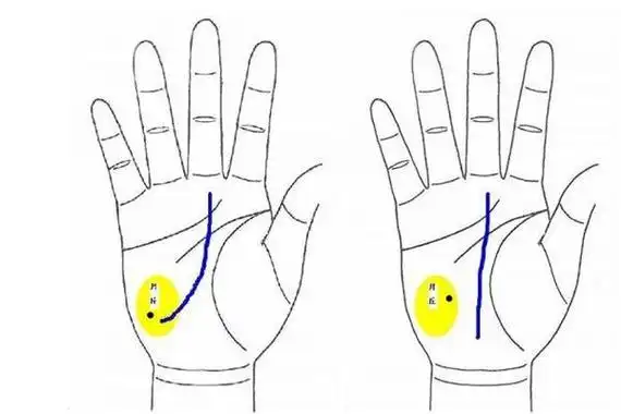 月丘有痣是好命运的手相吗?_八字命理