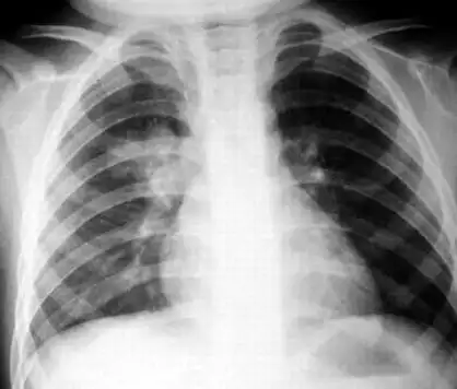 小儿支气管肺炎的诊断