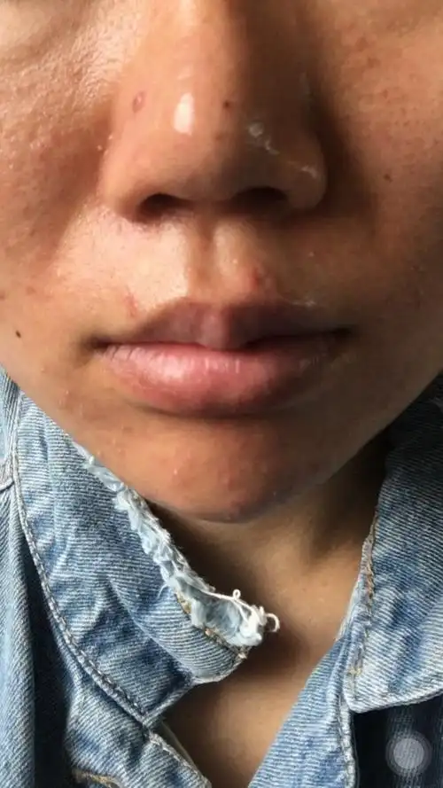 油性痘痘肌红血丝毛孔大皮肤暗沉.还有没有救呀?