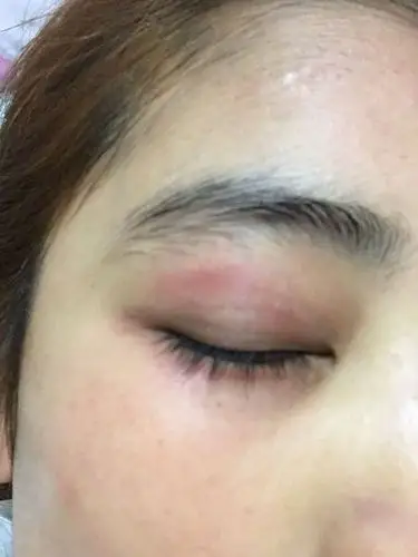 这样子要涂什么药膏吗?用地奈德软膏搭配红霉素眼膏,可以吗?