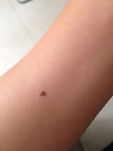 你好,去年在手臂上发现了一颗深棕色的痣,有些刺痒所以在冬天发觉了