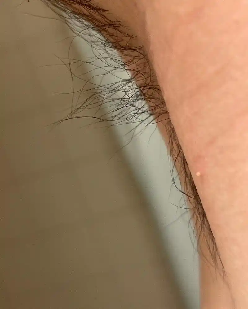 腋下表现是皮赘也叫软纤维瘤,是湿热潮也就是出汗比较多,刺激引颇的