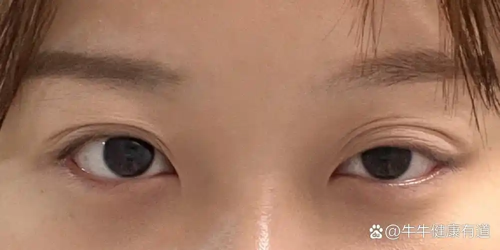 去年1月份确诊的眼肌型重症肌无力,只有眼皮耷拉了,身体没有不适