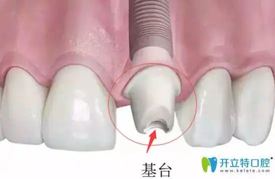 戳进来看看就知道种植牙基台种植牙二期修复发布时间