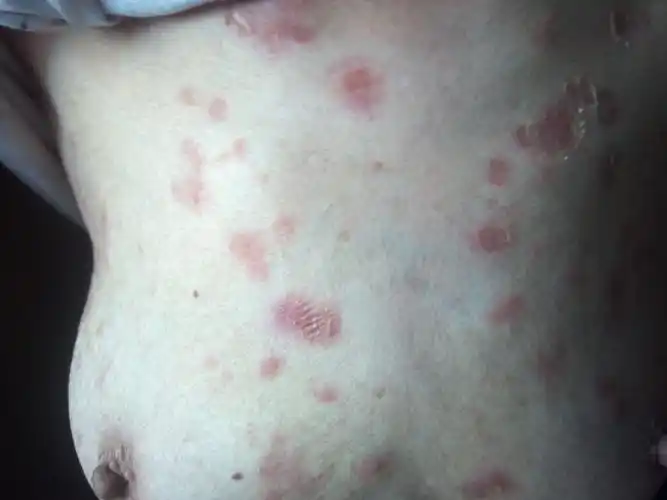 躯干部散在分布红斑,糜烂,结痂伴瘙痒半年