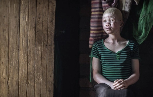 随时可能被"猎杀"的白化症男女,警察24小时持枪保护