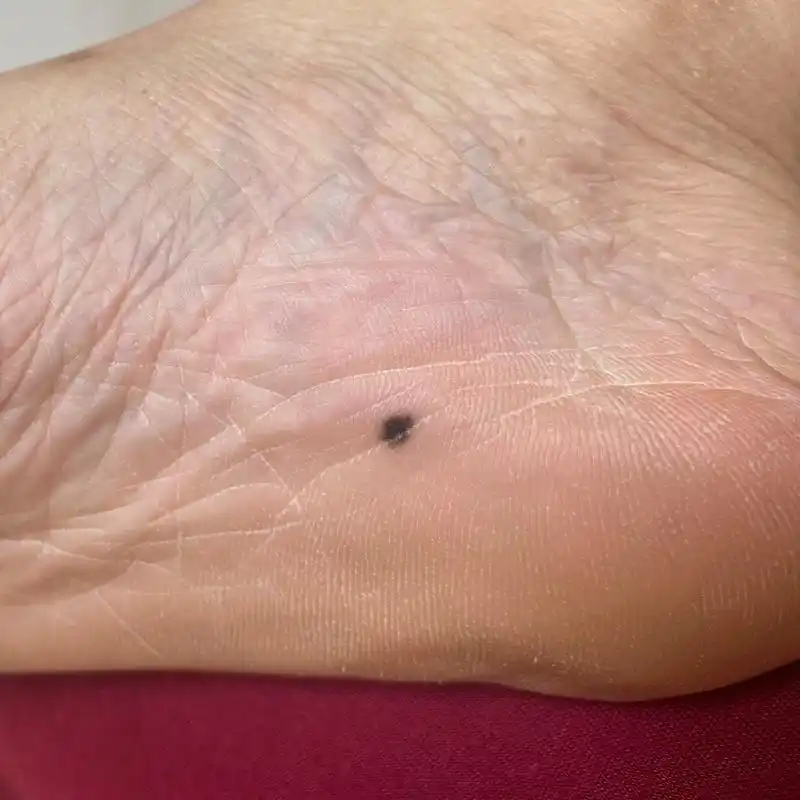 脚底痣 这颗痣五年前长的 我妈一直都在说去医院看看,然后平时也有点