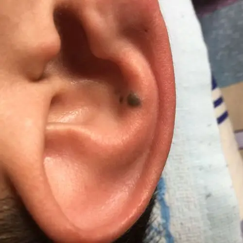 我儿子今年二十五岁,右耳朵中间有颗褐色痣,最近发现痣的边上多了两颗