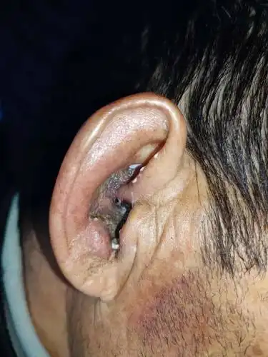 耳带状疱疹合并面瘫的治疗分析