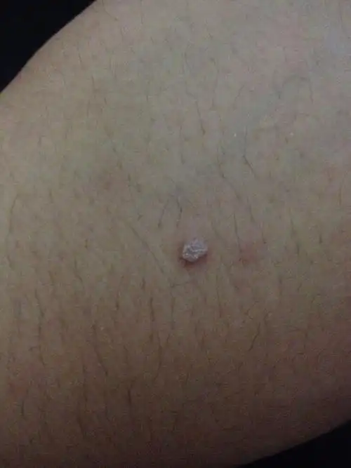 大概有两年了吧,手背上一直长着一个肉疙瘩,不疼也不痒,每次用指甲刀