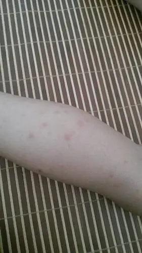 小孩子这是蚊子咬的还是水土不服,只有手脚屁股上面有,身上又没有