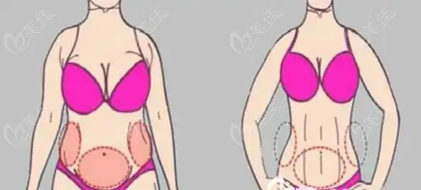 石家庄雅芳亚整形做的吸脂手术除了腰腹吸脂以外,还能做单部位吸脂