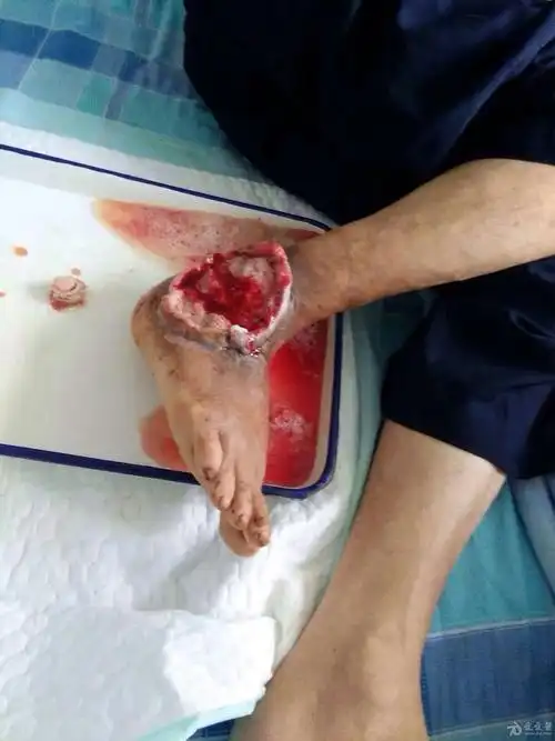 乳腺癌晚期侵入筋膜胸肌表面溃烂并转移同侧腋下淋巴癌