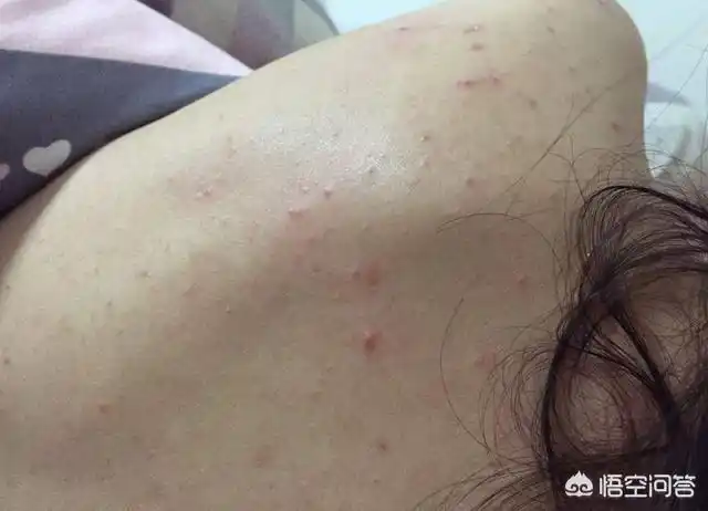 头条问答 - 后背螨虫如何自测?(7个回答)