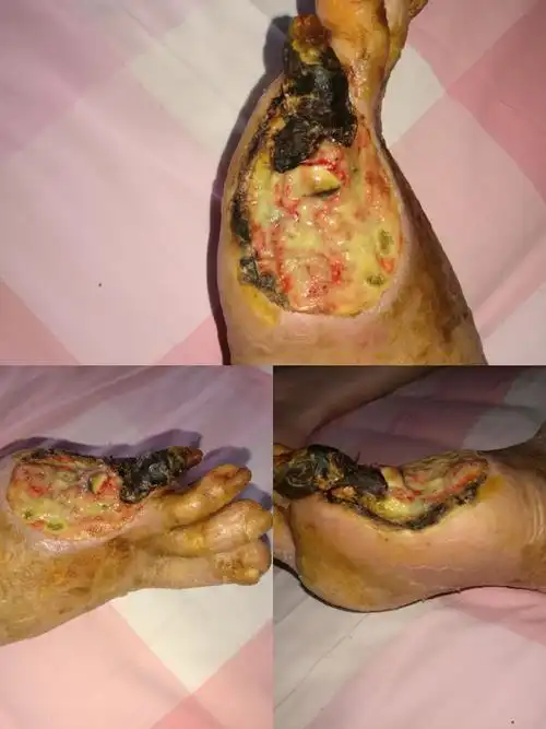 入院时创面情况,坏死组织多,肉芽生机不良
