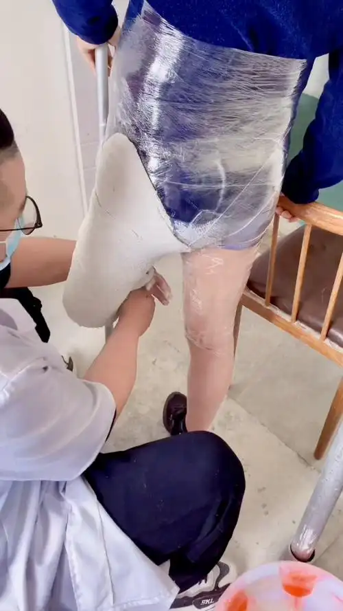 大腿假肢,取型制作中