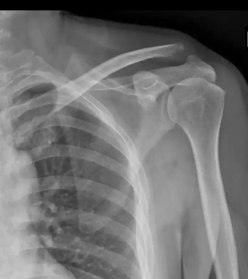 肩锁关节脱位的微创治疗 - 抖音