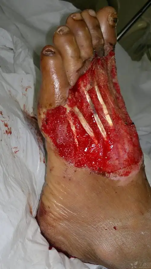 【 求助】请教各位专家,这样的创面该如何修复? [病例帖]