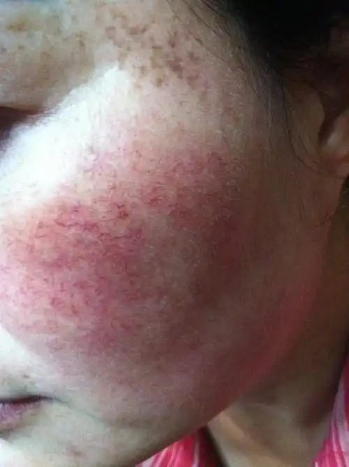 多年前由于去美容院祛斑,导致皮肤表层变薄,到现在角质层被破坏,脸上