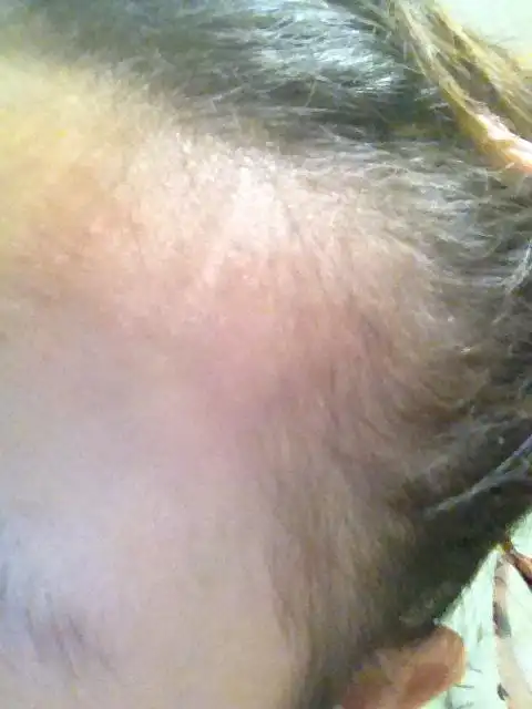 女生鬓角秃怎么办?是天生的吗