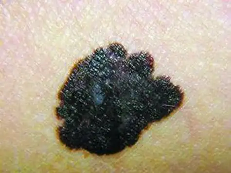 黑色素瘤的症状黑色素瘤图片