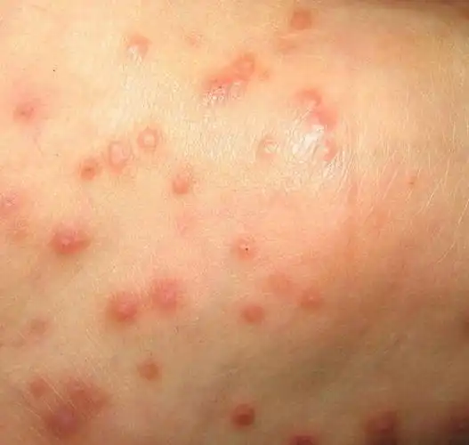 皮肤产生湿疹的原因是什么?