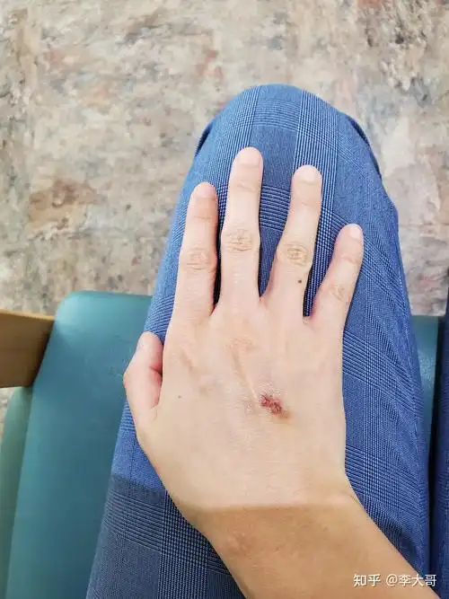 右手背黑色素瘤自行消退经历