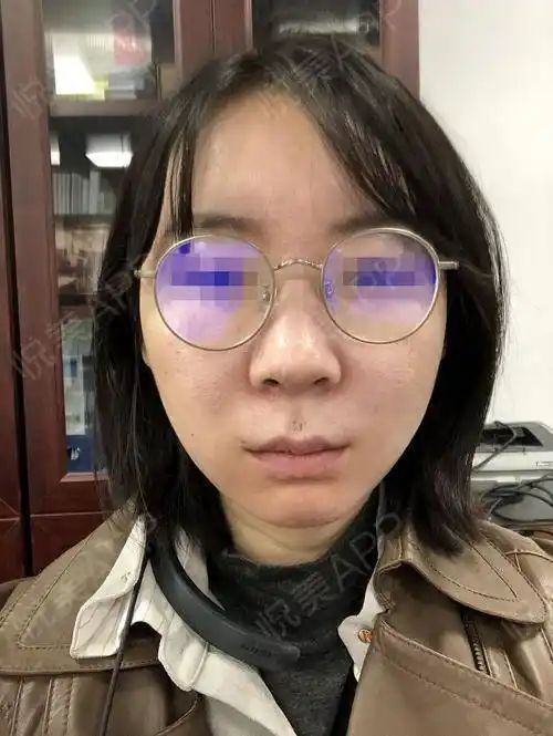 自体脂肪面部填充10天了,面部状态基本稳定了,填充的.