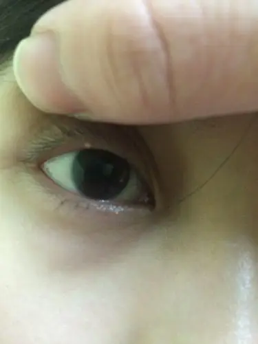 上眼皮边上长了一粒痘 这是长什么了 要怎么办