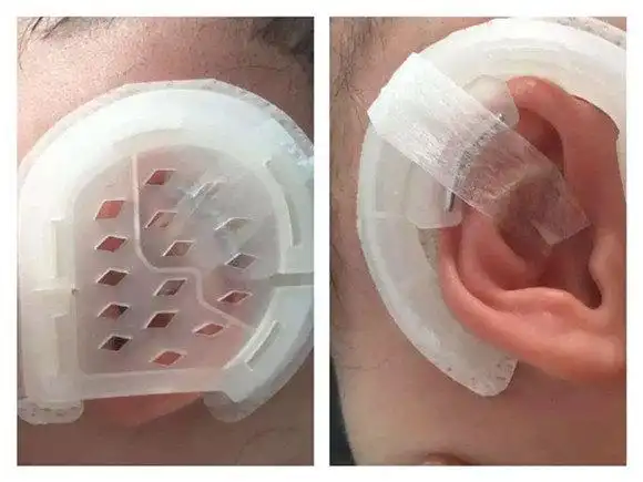 新生儿耳廓形态畸形无创矫正效果好 - 好大夫在线