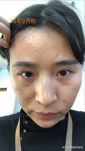 额头上的小痘痘怎么消除呀?