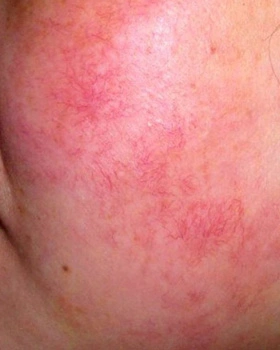 e光治疗红血丝常见问题