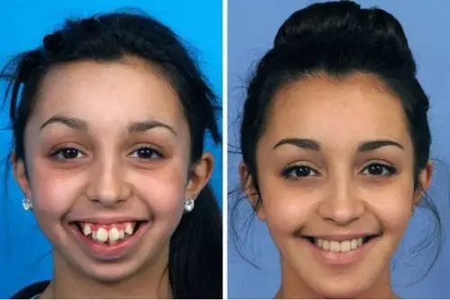 太赞了!这姑娘牙齿矫正后美爆了,牙不好看的你也可以