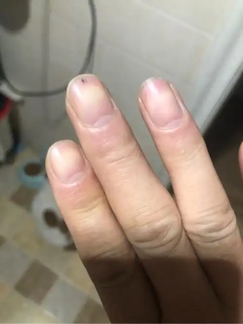 结疗9个多月,今天早晨发现平时正常的指甲变紫