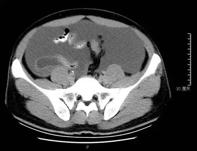 (3)肝脏多发小囊肿(见图2c);(4)肝内胆管轻度扩张,建议隔期复查