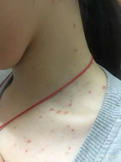 关于毛囊炎脂溢性皮炎痤疮的区别