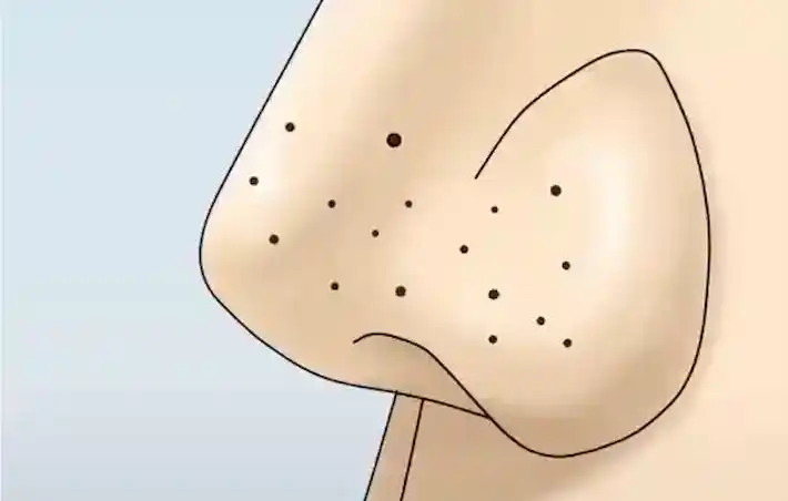 甲硝唑凝胶能去黑头吗?