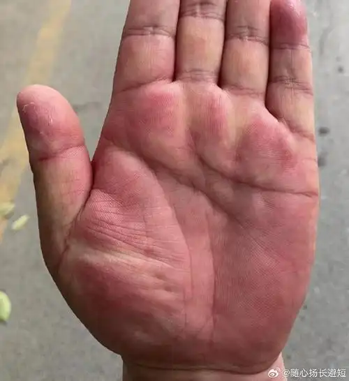 生命线旁边贴着一个三角纹,这是比较不好的征兆,暗示着你的身体会有