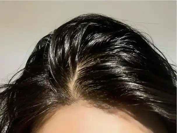 头发反复出油,早上刚洗完晚上就"打柳"