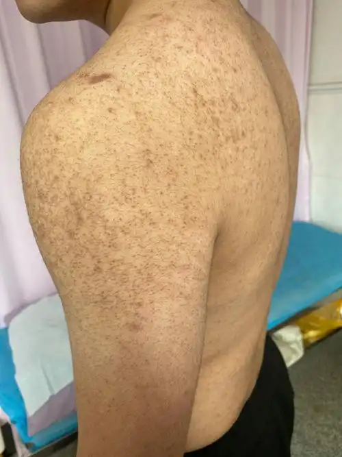 是一种  毛孔 漏斗角化十分  性皮肤病,毛周角化病在平时  人中占十分