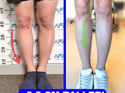 弯骨头也可以变直的,o型腿.