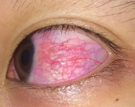 眼白充满红血丝,怎么办