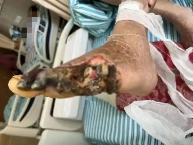 从脚部一个小伤口竟发展到要截肢?他究竟经历了什么_王大爷_血管_治疗