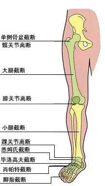 大腿截肢)——大腿假肢髋离断截肢——髋离断假肢半骨盆截肢——半