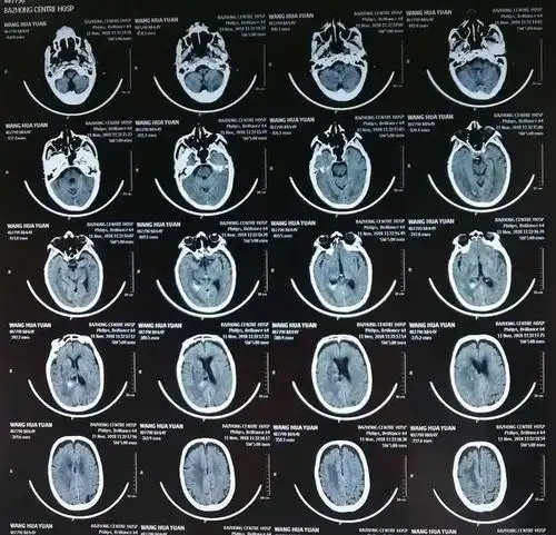 术后20天复查头颅ct基本正常